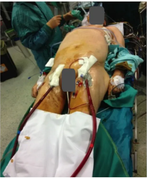 Fig	 .2	 Paziente	 sottoposto	 a	 trapianto	 bilaterale	 del	 polmone	 per	 PAH	 in	 V-A	 ECMO	 femoro-
