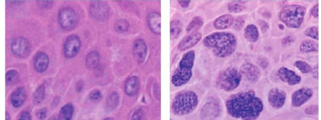 Figura  6.  Cambiamenti  strutturali  della  cromatina  nelle  cellule  tumorali.  Queste  due  microfotografie  sono  state  prese  da  un  paziente  con  un  carcinoma  a  cellule  squamose  della  pelle