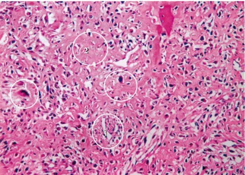 Figura  10.  Aspetto  dell’osteosarcoma  ad  alto  grado  di  malignità.  (1)  cellule  grandi,  pleiomorfiche  e  ipercromatiche  in  grado  di  produrre  matrice  osteoide;  (2)  matrice  osteoide  completamente  disorganizzata;  (3)  abbondanti  vasi  s