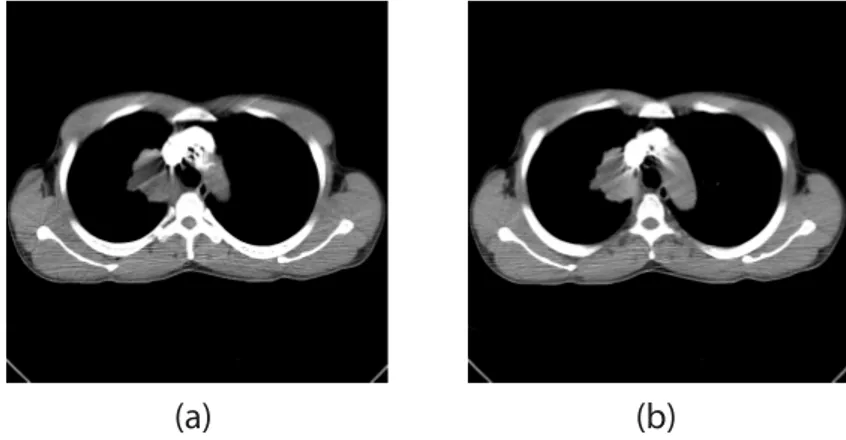 Fig. 4.3: Lung CTp images aﬀected by beam hardening causing dark bands (a) and streaks (b).
