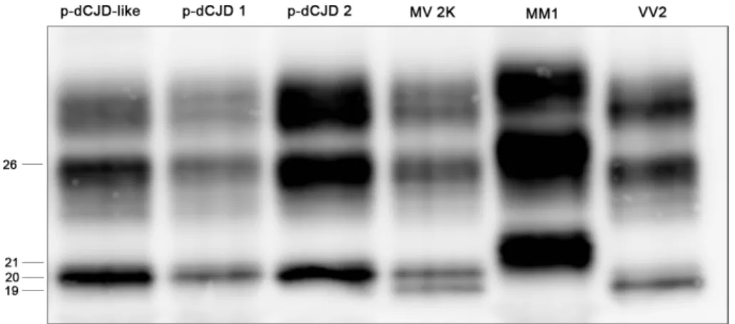 Figura  16:  Western  blot  della  PrP Sc   associata  al  fenotipo  p-dCJD  e  simili  (MMiK),  a  confronto  con  la  PrP Sc  tipo 1 (21 kDa, sCJDMM1), tipo 2 (19 kDa