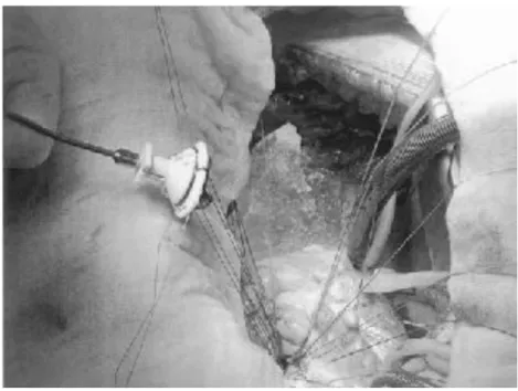 Figura  3-13.  Le  suture  pivot  guards  orientate  verso  la  coronaria  sinistra  e  la  coronaria  destra