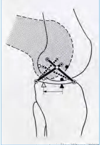 Fig.  2.6  -  Comportamento  dei  due  fasci  del  legamento  crociato  anteriore  durante  la  flessione  del  ginocchio (AA’ = fascio AM, BB’ = fascio PL), vedi testo per dettagli