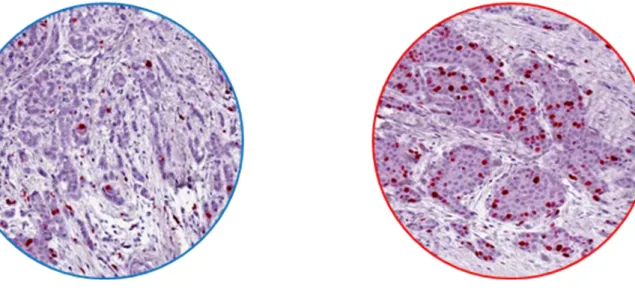 Figura 2 Colorazione in ematossilina-eosina di un carcinoma tubulare, un carcinoma midollare ed un  carcinoma adenoido-cistico della mammella 