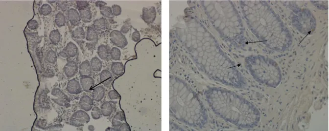 Fig.  13.  Distribution  of  CB2  receptors  immunoreactivity    in  preoneoplastic  and  neoplastic  lesions  in  colorectal cancer.