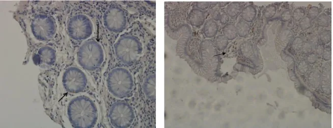 Fig. 14.  Distribution of FAAH receptors immunoreactivity  in preoneoplastic and neoplastic lesions in  colorectal cancer.