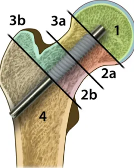 Figure  2: Draft of the four ROIs for the evaluation of osteolysis in the AP hip X  ray