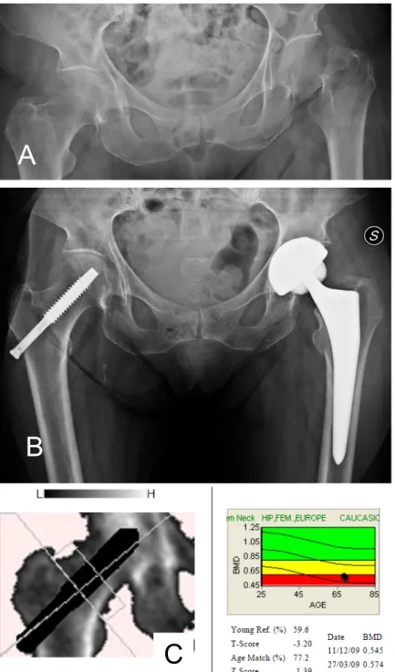 Figure  3:  67  year  old  female  patient;  A.  AP  pre-operative  X  ray  shows  a  left  femoral neck fracture; B