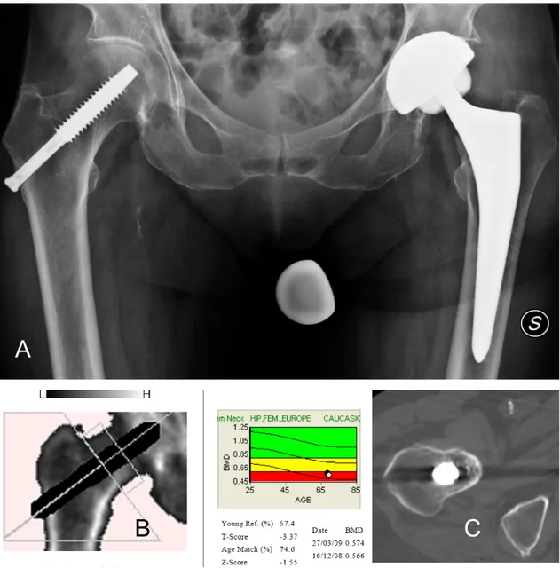 Figure 4: 12 months FU. A. No osteolisys are present in the reinforced neck. B. 