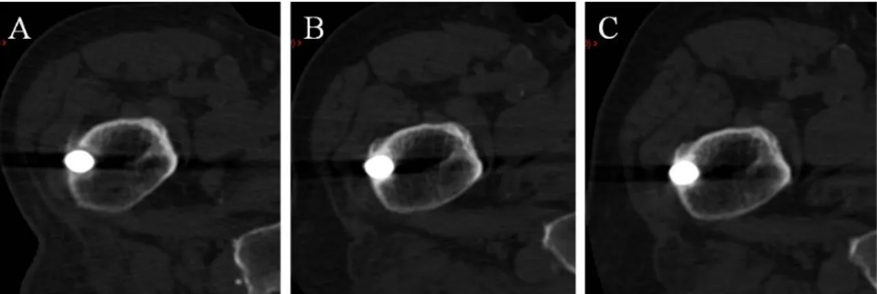 Figure  5:  CT  slices  of  the  same  patient  at  different  FU;  A.  Three  months  FU: 