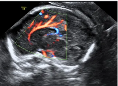 Figura 6: immagine neurosonografica del corpo calloso e dell’ arteria pericallosa in un feto a 21  settimane di gestazione 