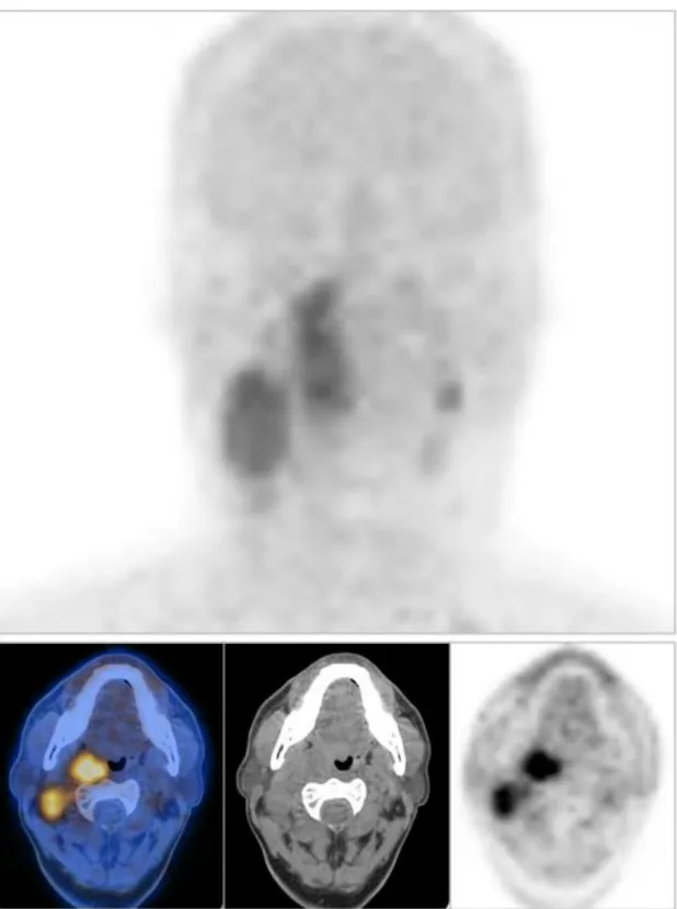 Figura 3: Esempio di un paziente con tumore del testa-collo avanzato studiato con 64Cu- 64Cu-ATSM  PET/CT  prima  della  chemio/radioterapia  combinata:  nelle  immagini  sopra  troviamo  il  MIP  (maximum  intensity  projection)  e  le  immagini  assiali 