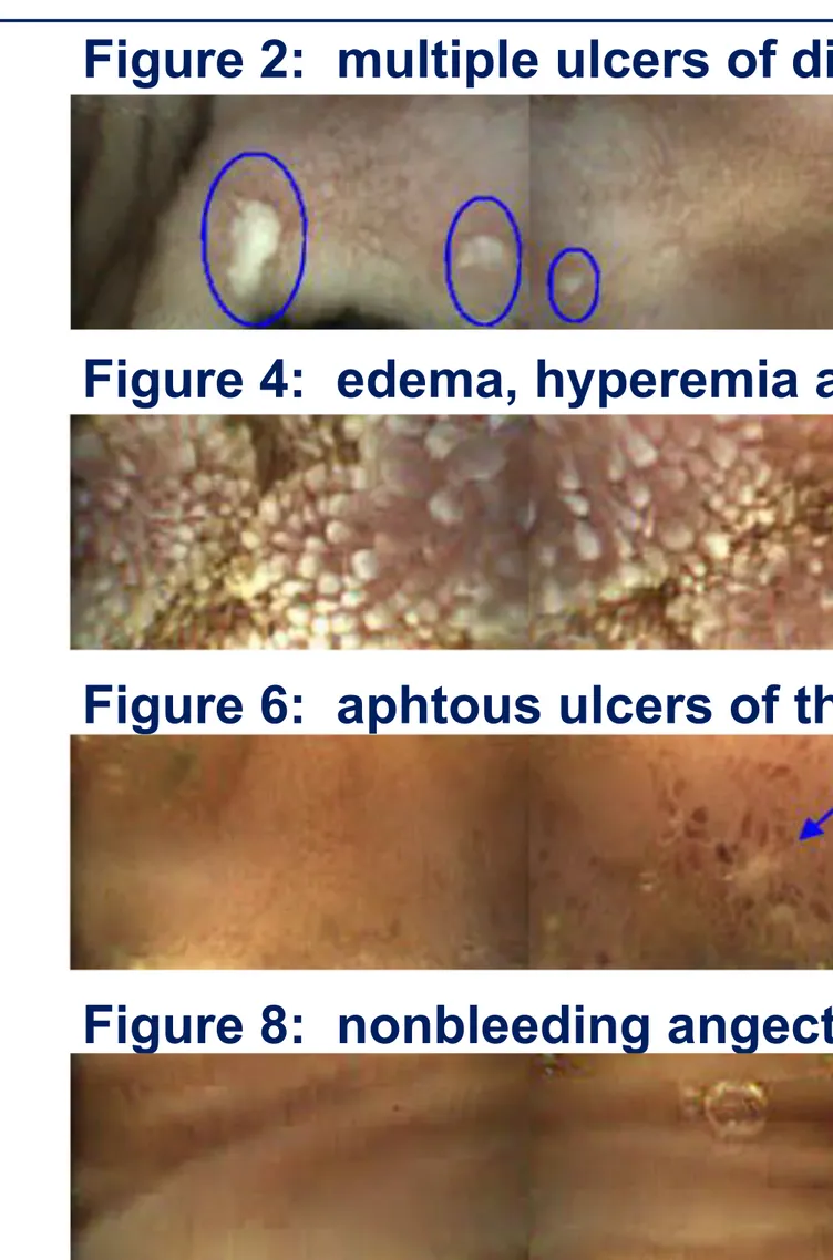 Figure 2:  multiple ulcers of distal jejunum, later diagnosed as CD