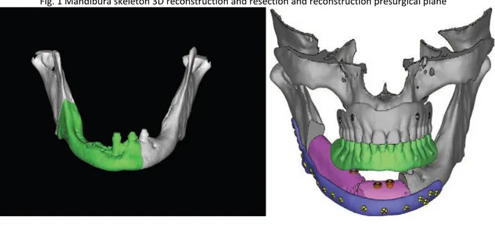 Fig. 1 Mandibura skeleton 3D reconstruction and resection and reconstruction presurgical plane 