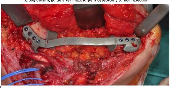 Fig. 3A) Cutting guide after Piezosurgery osteotomy tumor resection 