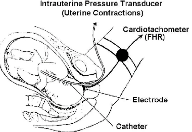 Figure 3.1 - Insertion of a catheter through intrauterine applicator. Source: The Brookside  Associates [Online]