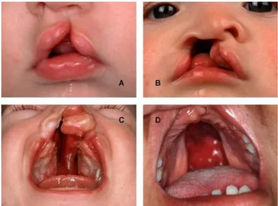 Figura 2. Variabilità fenotipica delle schisi orofacciali: (A) Schisi unilaterale incompleta del labbro; (B) schisi  unilaterale di labbro, alveolo e palato; (C) schisi bilaterale di labbro, alveolo e palato; (D) palatoschisi  isolata (Stoll, et al., 2004)