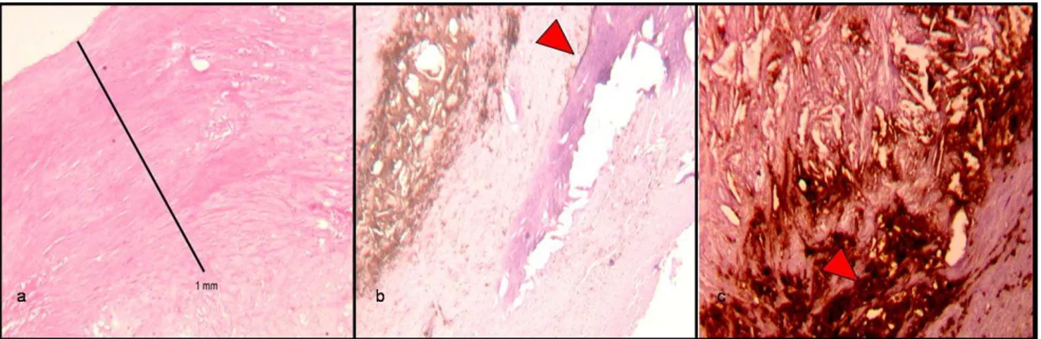 Figura  5:  varie  tipologie  di  placche  carotidee,  a)  placca  fibrosa,  b)  placca  con  componente  calcifica,  evidenziata dalla freccia, b) placca con ricca componente flogistica, evidenziata dalla freccia