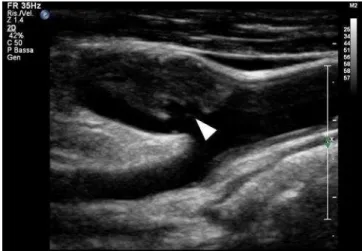 Figura 6: placca ulcerata a livello della superficie del  fibrous  cap  (freccia),  identificata  mediante  valutazione  ecografica