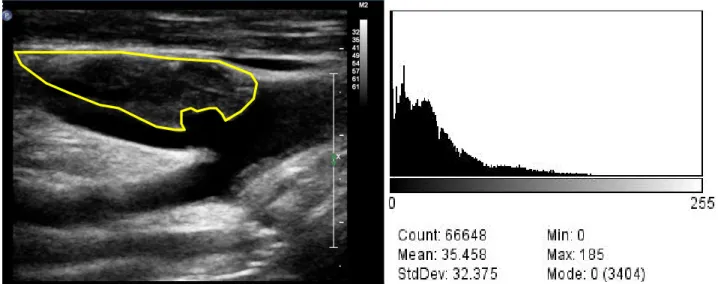 Figura 7: valutazione del Gray Scale Mesurament (GSM). A livello della regione di interesse (placca) viene  calcolata la media della scala di grigi ricavando un valore numerico che ne indica il grado di ipoecogenicità