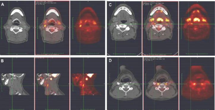 Figura  8:  immagini  di  Tomografie  ad  Emissione  di  Positroni  con  18  fluorodesossiglucosio  (PET-FDG)  con  uptake  a  livello  della  carotide  interna  destra  in  tre  pazienti