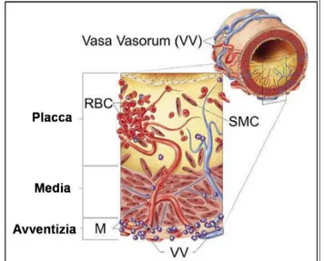 Figura  9:  schematizzazione  della  neoangiogenesi  intraplacca.  I  microvasi  prendono  origine  dai  Vasa  Vasorum  esterni  alla  carotide  penetrando  nella  placca  favorendo fenomeni emorragici al suo interno