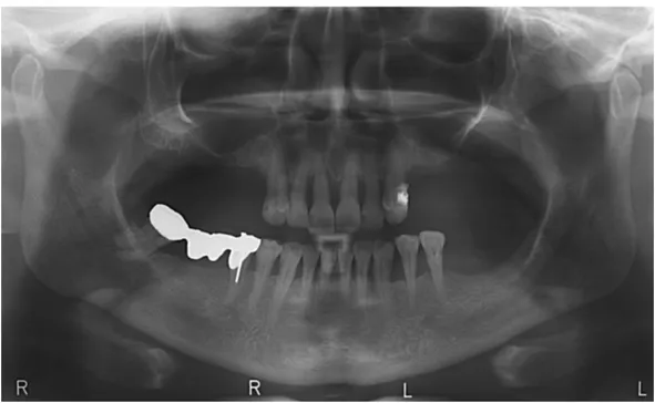 Fig.  3  Ortopantomografia  di  un  paziente  edentulo  da  circa  3  anni  con  marcata  atrofia  bilaterale a livello dei seni mascellari 