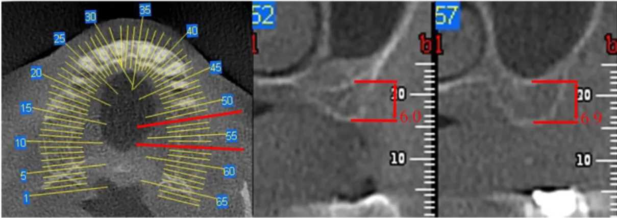 Fig.  9a.  TC  preoperatoria  di  un  caso  sottoposto  a  rialzo  di  seno  e  inserimento  contestuale di impianti standard 