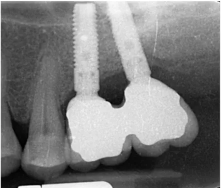 Fig.  9f.  Visione  clinica  laterale  immediatamente  dopo  il  montaggio  della  protesi  fissa  definitiva