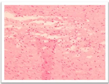 Figure 2. Isolated clusters of intimal macrophagic foam cells. 