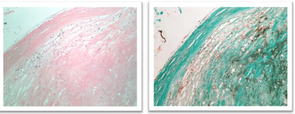 Figure 3. Fatty streak. The macrophagic foam cells form stratified intimal layers. 