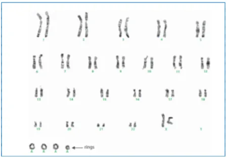 Figura  2:  cariotipo  del  tumore  lipomatoso  atipico/liposarcoma  ben  differenziato  con  cromosomi ad anello (Hameed, 2007)
