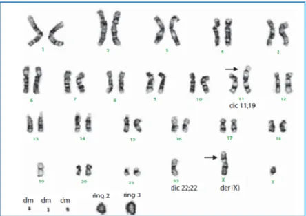 Figura 4. Cariotipo del liposarcoma dedifferenziato dove si osservano cromosomi ad anello e  double minutes (dm) (da Hameed M., 2007) 