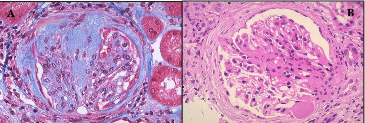 Figura 16 FSGS A) nella prima  immagine una sezione istologica renale colorata con Tricromica  di Masson  che  mette  in  evidenza  il  collagene  (azzurro)  (University  of  Utah,  2013);  B)  nel  preparato  colorato  con  ematossilina&amp;eosina è evide