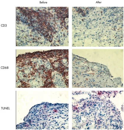 Figura 2: Immagine rappresentativa della colorazione immunoistochimica di CD3+ e CD68+ e TUNEL assay nel  tessuto  sinoviale  al  tempo  zero  e  dopo  48  ore  dall’infusione  con  Infliximab