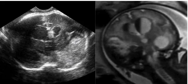 Fig. 3 Ecografia/RMN (T2 SSFSE): Emorragia cerebrale di 4° grado   (34 settimane). Sezioni coronali