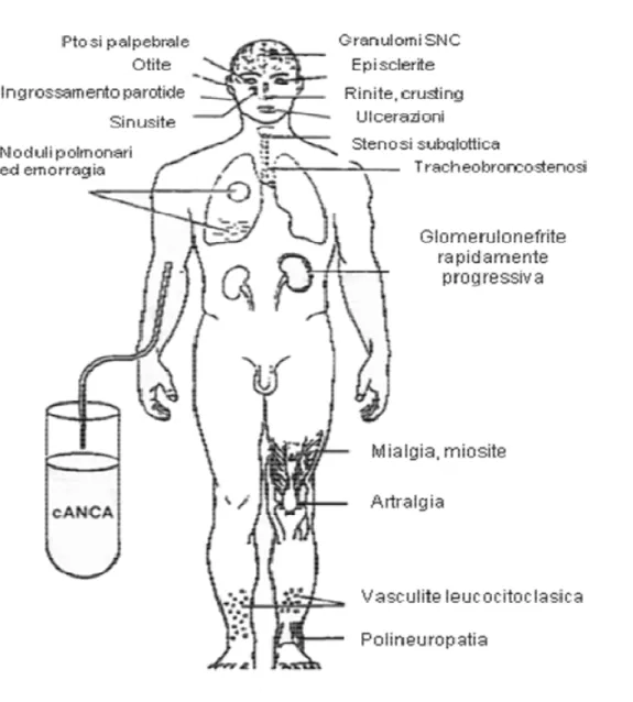 Figura 1.  Principali manifestazioni cliniche della Granulomatosi di Wegener (GW). 