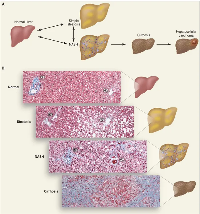 Fig. 1  Lo spettro della Non-Alcoholic Fatty Liver disease. (A) Progressione schematica della NAFLD