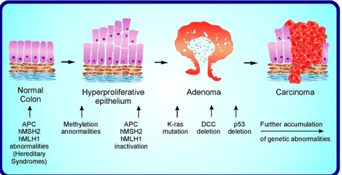 Figura 1:  Schema della progressione adenoma-carcinoma 