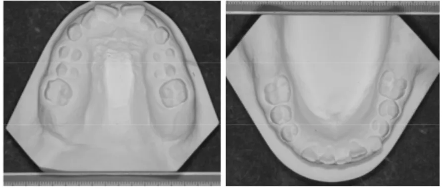 Figura  2.4:  Teleradiografie  latero-laterale  di  bambino  di  7  anni  affetto  da  SN