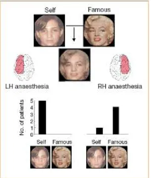 Figura  2:  esempi  di  volti  realizzati  con  la  tecnica  del  morphing  e  risposte  date  dai  soggetti  in  seguito  rispettivamente  a  anestesia  dell’emisfero  sinistro  e  dell’emisfero destro (Keenan e coll., 2001)