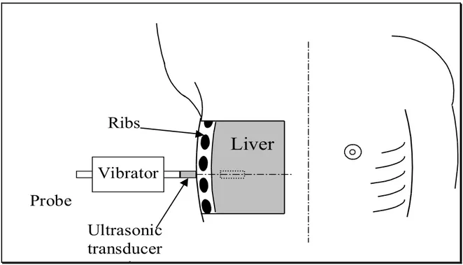 Figure	
   1.	
   Fibroscan	
   probe	
   is	
   correctly	
   placed	
   in	
   the	
   intercostal	
   space.	
   After	
   generation	
   of	
   vibration,	
  the	
  US	
  transducer	
  collects	
  the	
  information	
  about	
  tissue	
  dislocation	
 