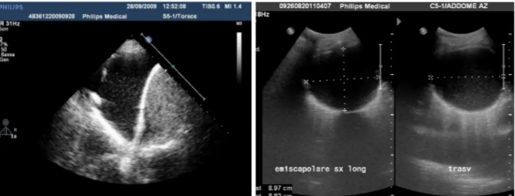 Figura 5 (sinistra): scansione longitudinale posteriore a paziente seduto con sonda   seoriale di versamento pleurico libero, raccolto alla base dell’emitorace.
