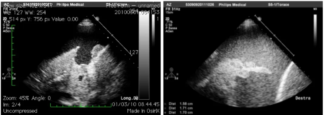 Figura 8. Reper collaterali nella diagnosi di versamento pleurico: a sinistra nodulazioni   del   proflo   diaframmaco;   a   destra   noduli   ipoecogeni   nel   parenchima   polmonare   collassato.