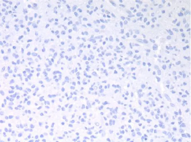 Figura 6. Oligodendroglioma,caso 32: nessuna cellule era positiva per CDC-20.