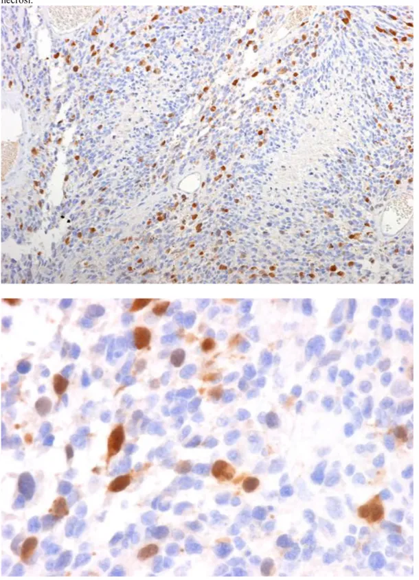 Figura 7A e 7B. Glioblastoma, caso 19: A: Immunopositività nucleare per CDC-20. Le cellule positive sono prevalentemente localizzate attorno alle aree necrotiche