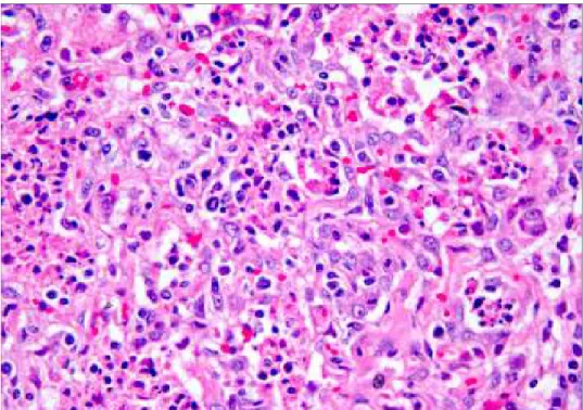 Figura 1.2. Suino. Polmone. La sezione mostra ipertrofia ed iperplasia degli pneumociti di II tipo e  materiale necrotico intralveolare