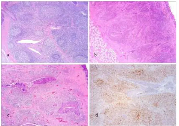 Figura 2.4. Suino, tonsilla a: aspetto istologico normale. Presenza di follicoli linfatici e tessuto  interfollicolare, E&amp;E, 5x; b: PMWS, moderata deplezione linfoide con scomparsa dei follicoli e rarefazione 