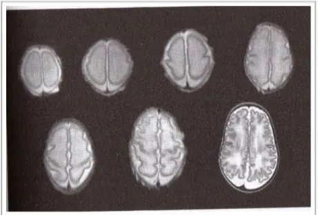 Figura 4. Immagini di cervelli del feto ottenute mediante risonanza magnetica, dalla 23 a  settimana  di gestazione (in alto a sinistra) fino al termine di 40 settimane