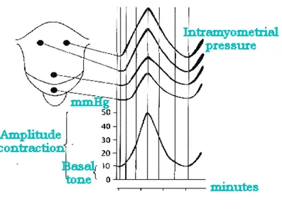 Figure 6: effect of triple descending gradient and resulting uterine contraction 